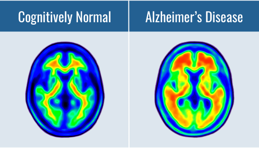 PET scan for amyloid beta showing little uptake of tracer in the brain of a cognitively normal individual, but increased uptake in the brain of an individual with Alzheimer's disease